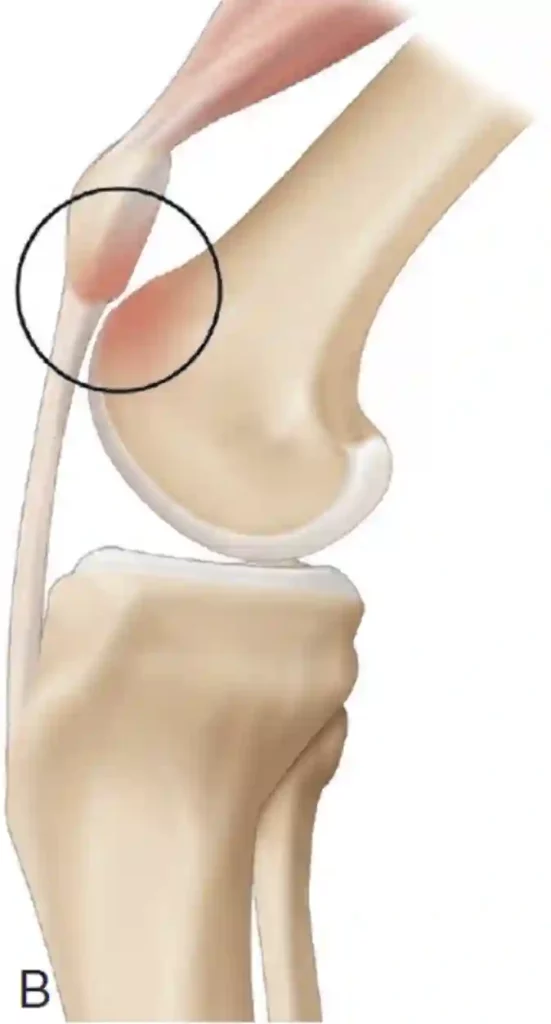 image des Douleurs de rotule