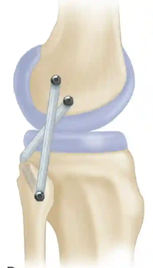 Multiligamentaire en une image