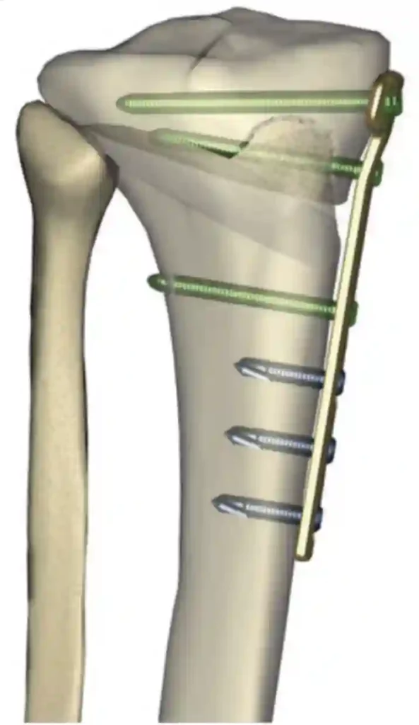 Ostéotomies en une image