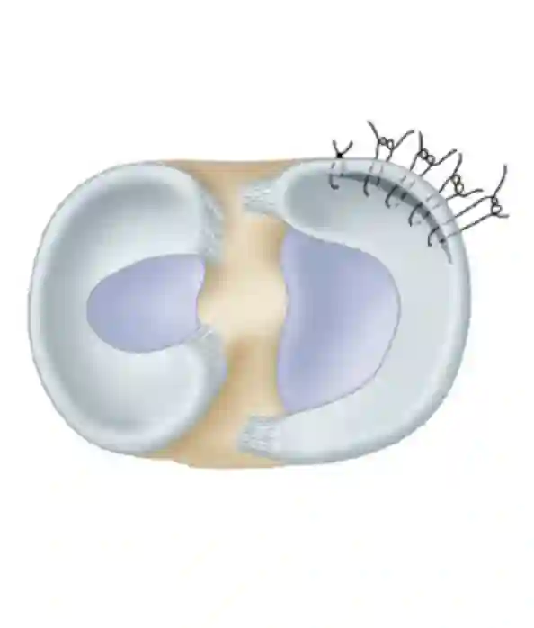 Suture méniscale en une image