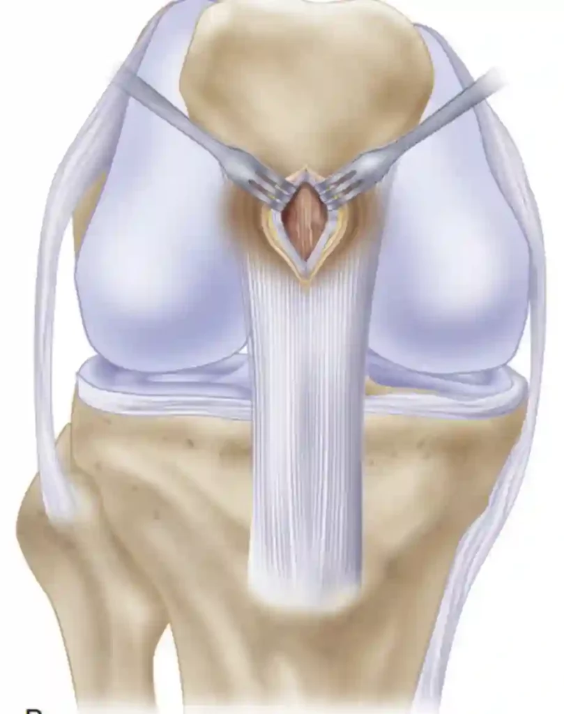 Tendinopathie/tendinite en une image